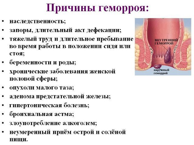 Геморрой наружный лечение и диагностика
