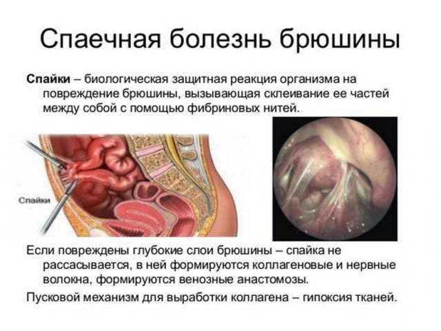 Спайки в малом тазу: что это. Симптомы, причины, диагностика и лечение спаек в малом тазу