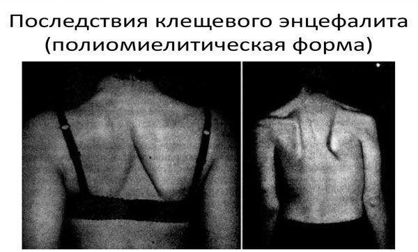 Клещевой энцефалит: диагностика, симптомы и лечение заболевания