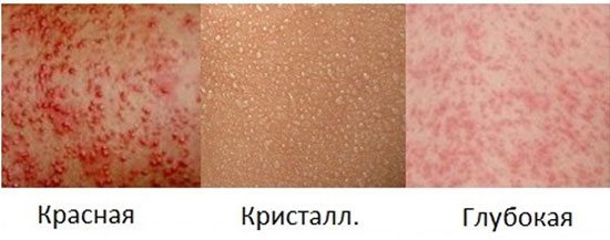 Потница у взрослых - фото, симптомы и лечение проявлений потницы