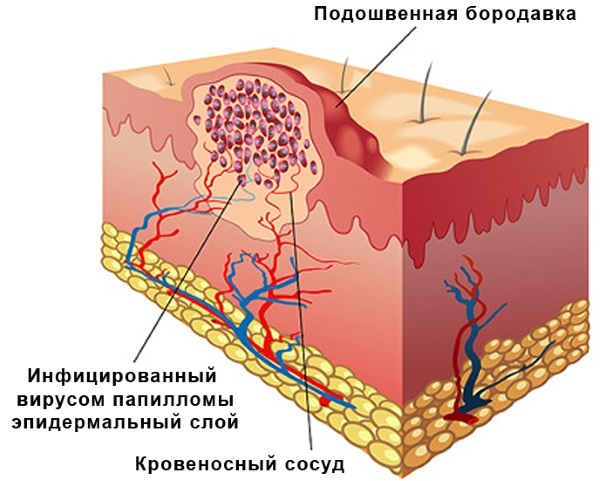 Ляписный карандаш от папиллом, инструкция по применению и отзывы
