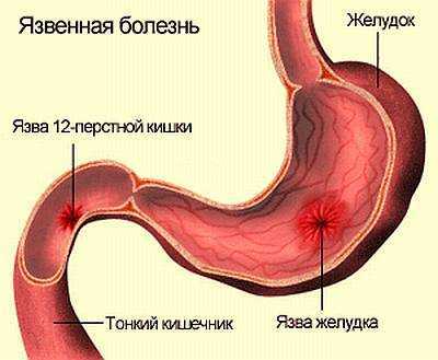 Язва двенадцатиперстной кишки: симптомы и лечение