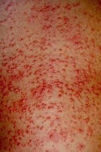 Потница у взрослых - фото, симптомы и лечение проявлений потницы