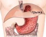 Грыжа пищеводного отверстия диафрагмы (ПОД): что это такое, симптомы, лечение