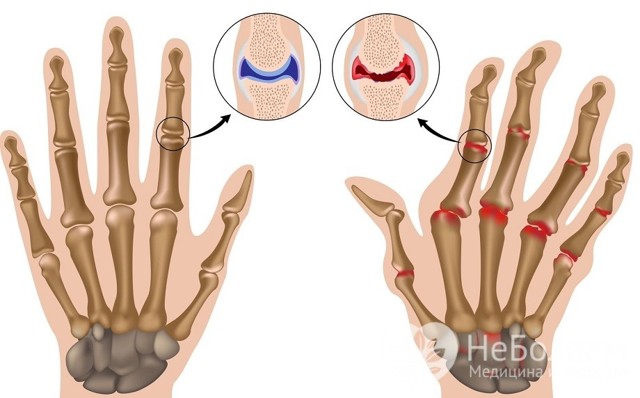 Артрит - симптомы, причины, лечение заболевания