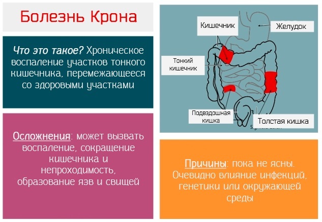 Болезнь Крона - симптомы и лечение у взрослых, причины, диагностика