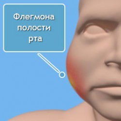 Флюс на десне: лечение, фото, причины возникновения