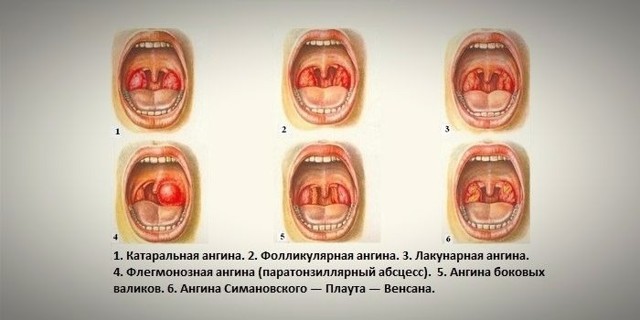 Как лечить боль в горле при глотании без температуры