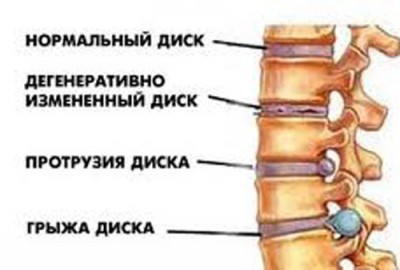 Остеохондроз поясничного отдела позвоночника: симптомы и лечение