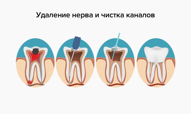 Болит зуб после удаления нерва - причины и лечение, народные средства. Как предотвратить зубную боль после удаления нерва - Автор Екатерина Данилова