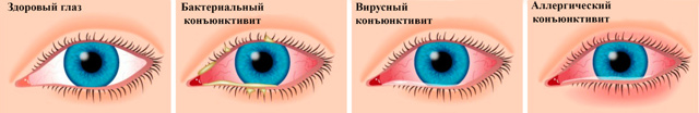 Конъюнктивит: причины, симптомы и лечение конъюнктивита