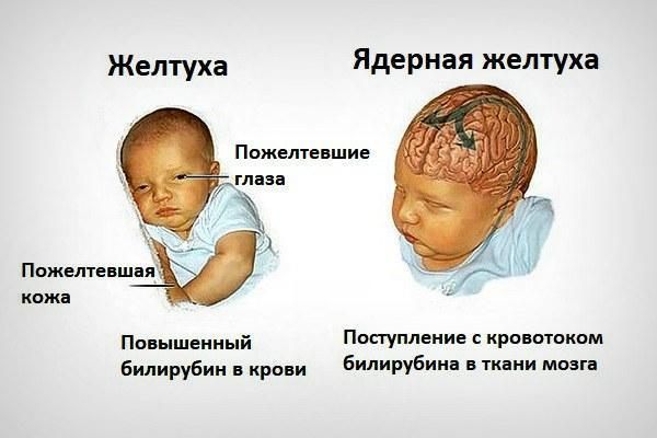 Желтые белки глаз: причины симптомы и лечение